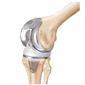 Total-Knee-Replacement